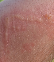dermatite